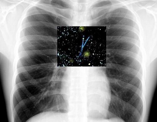 游離二氧化硅對人體的危害 游離二氧化硅對人體的危害